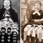 Myrtle Corbin: la mujer con 4 piernas que ha formado una familia