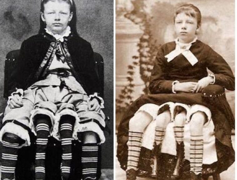 Myrtle Corbin: la mujer con 4 piernas que ha formado una familia