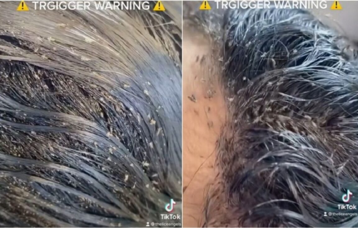 Un vídeo se hace viral: una niña con más de 15.000 piojos en la cabeza