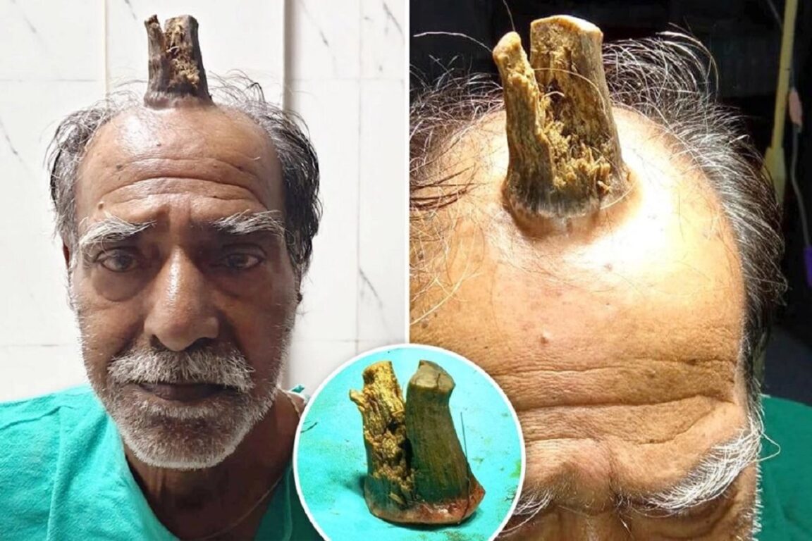 Un hombre se golpea la cabeza y le crece un «cuerno» de 10 cm que requiere cirugía