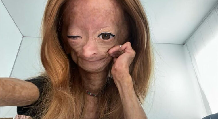 adalia rose enfermedad benjamin button