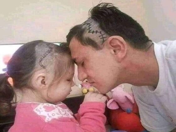 Un padre se afeita la cabeza por su hija operada del cerebro; Internet se emociona