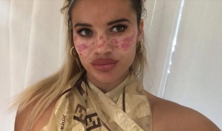 Una modelo e influencer acaba con la cara quemada tras probar un truco de belleza de TikTok