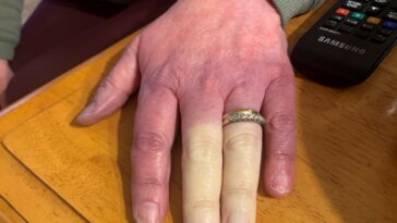 Una madre tiene los dedos blancos y completamente entumecidos a causa de un extraño trastorno