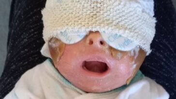 La piel seca de un bebé se convirtió en un duro «caparazón de tortuga» que le impidió respirar al nacer